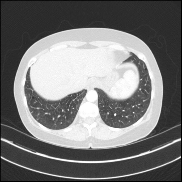 File:Adenocarcinoma of the lung (Radiopaedia 44205-47803 Axial lung window 75).jpg