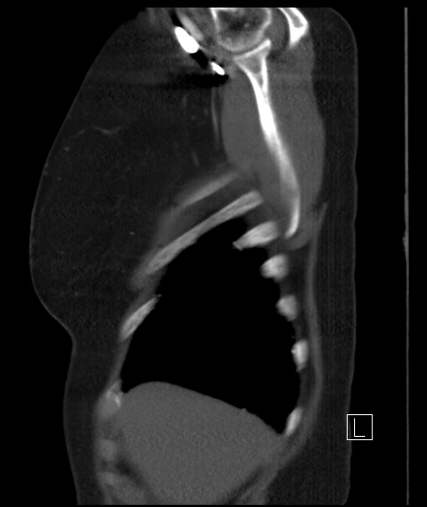 Adenocarcinoma of the lung (Radiopaedia 44205-47803 Sagittal C+ portal venous phase 51).jpg