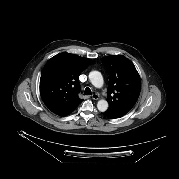 File:Adenocarcinoma of the lung (Radiopaedia 44876-48759 Axial C+ portal venous phase 30).jpg