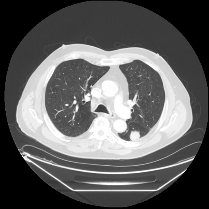 Adenocarcinoma of the lung (Radiopaedia 44876-48759 Axial lung window 31).jpg