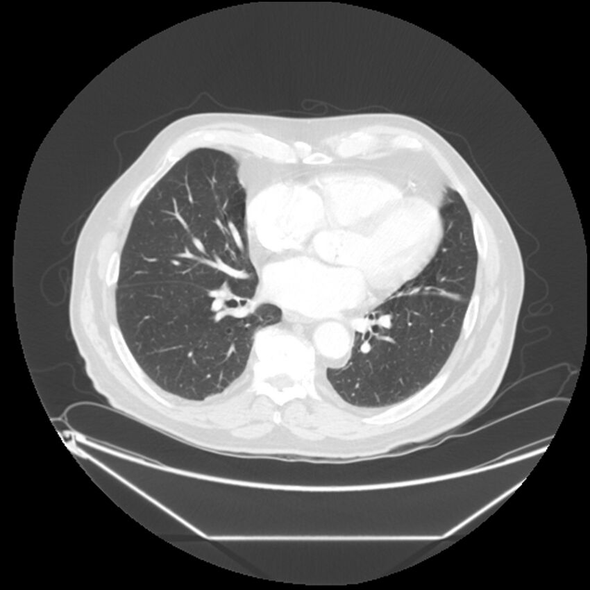 Adenocarcinoma of the lung (Radiopaedia 44876-48759 Axial lung window 49).jpg