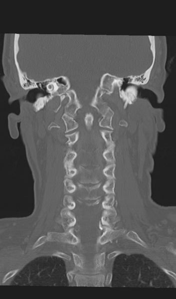 File:Adenoid cystic tumor of palate (Radiopaedia 46980-51518 Coronal bone window 42).png