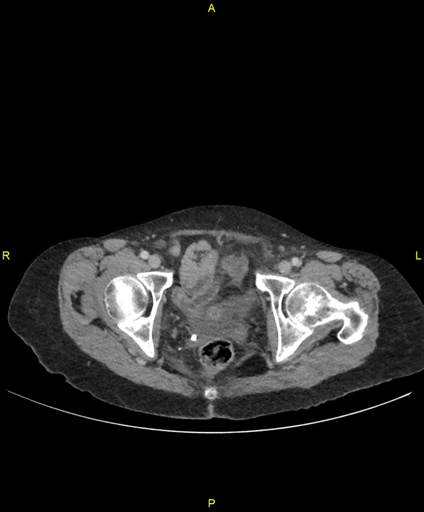 Adhesional small bowel obstruction (Radiopaedia 85402-101024 Axial C+ portal venous phase 273).jpg