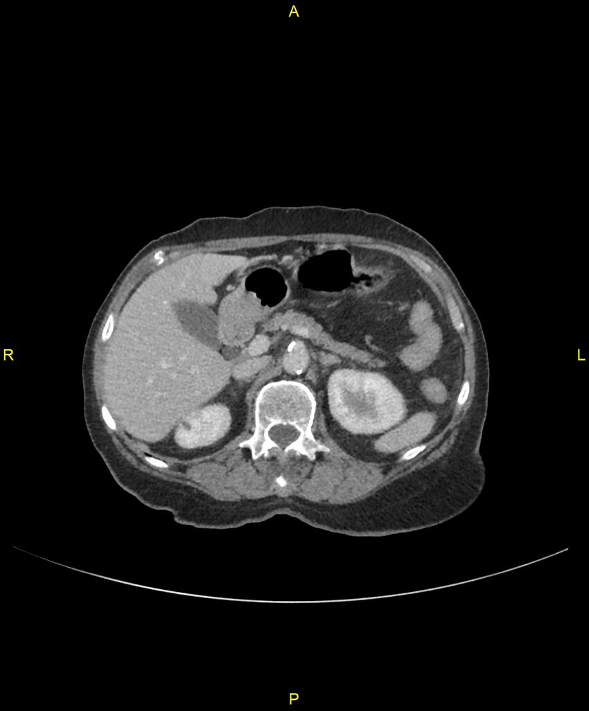 Adhesional small bowel obstruction (Radiopaedia 85402-101024 Axial C+ portal venous phase 88).jpg