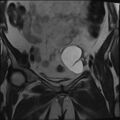 Adnexal multilocular cyst (O-RADS US 3- O-RADS MRI 3) (Radiopaedia 87426-103754 Coronal T2 11).jpg