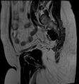 Adnexal multilocular cyst (O-RADS US 3- O-RADS MRI 3) (Radiopaedia 87426-103754 Sagittal T2 5).jpg