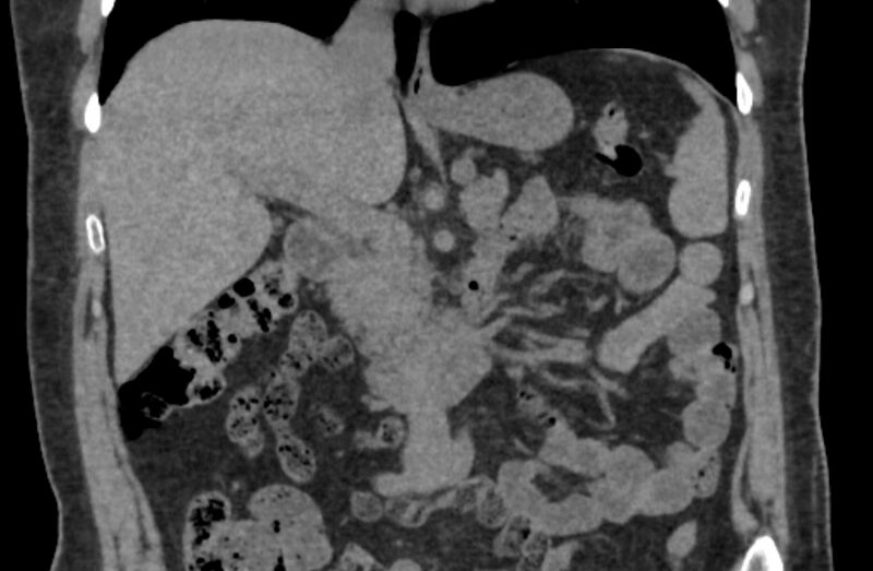 File:Adrenal myelolipoma (Radiopaedia 65240-74253 Coronal non-contrast 5).jpg