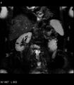 Adrenal myelolipoma (Radiopaedia 6765-7961 Coronal T2 fat sat 4).jpg