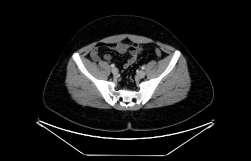 File:Adrenocortical carcinoma (Radiopaedia 80134-93438 Axial C+ portal venous phase 103).jpg