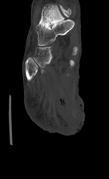 File:Advanced osteomyelitis due to open metatarsal fracture (Radiopaedia 83891-99095 Coronal bone window 14).jpg