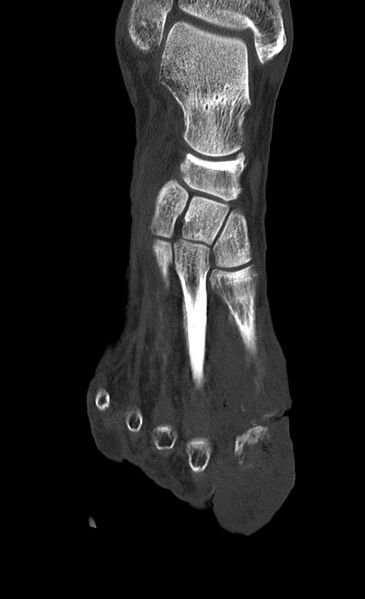 File:Advanced osteomyelitis due to open metatarsal fracture (Radiopaedia 83891-99095 Coronal bone window 7).jpg
