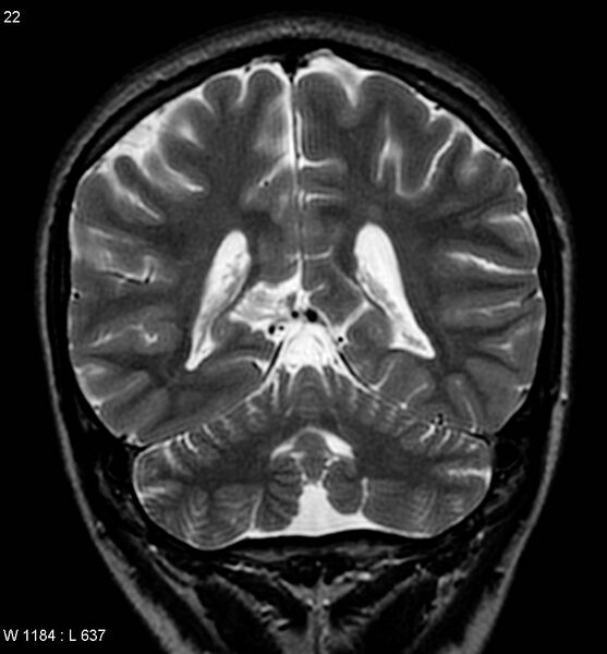 File:Aicardi syndrome (Radiopaedia 5353-7117 Coronal T2 20).jpg