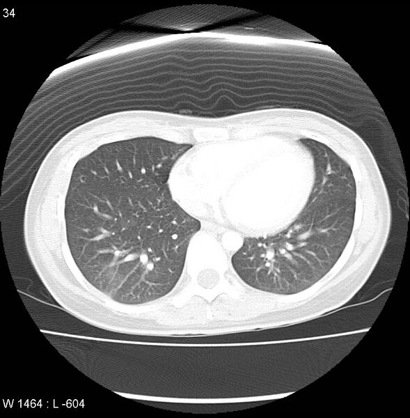 File:Air crescent sign (aspergilloma) (Radiopaedia 14380-14306 Axial lung window 15).jpg
