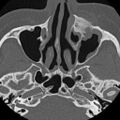 Ameloblastic fibro-odontoma (Radiopaedia 18843-18780 C 13).jpg