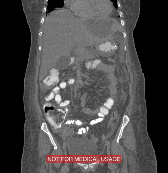 File:Amoebic enterocolitis with liver abscess (Radiopaedia 35100-36609 B 68).jpg