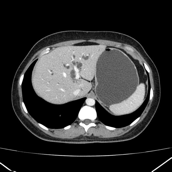 File:Ampullary tumor (Radiopaedia 22787-22816 C 13).jpg