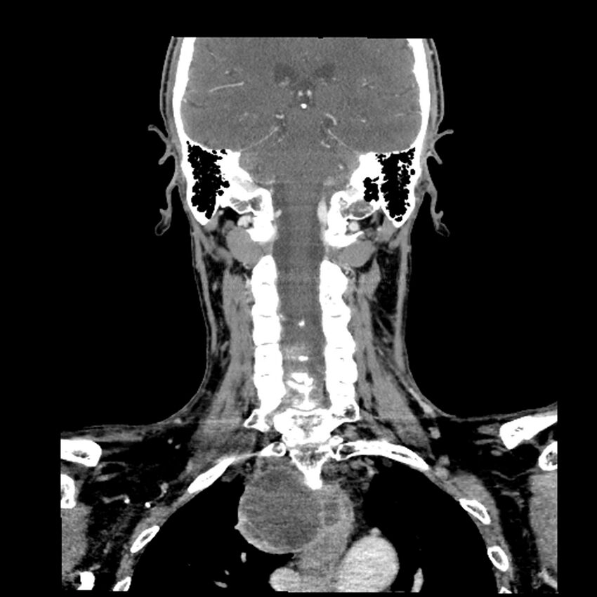 Anaplastic thyroid carcinoma (Radiopaedia 79087-92034 A 79).jpg