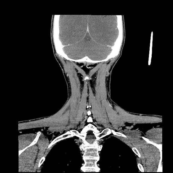 File:Anaplastic thyroid carcinoma (Radiopaedia 79087-92034 A 95).jpg