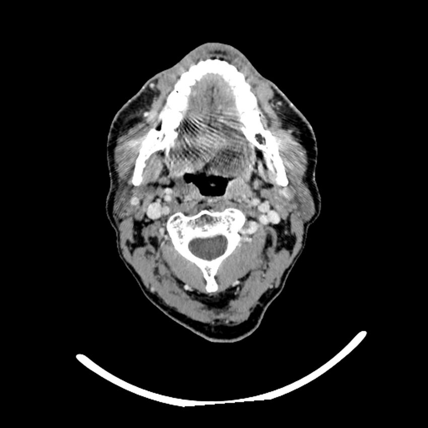 Anaplastic thyroid carcinoma (Radiopaedia 79087-92034 B 93).jpg