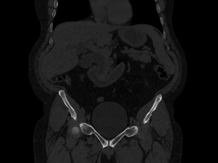Ankylosing spondylitis (Radiopaedia 44609-48357 Coronal bone window 10).jpg