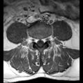 Ankylosing spondylitis with zygapophyseal arthritis (Radiopaedia 38433-40516 Axial T1 8).jpg