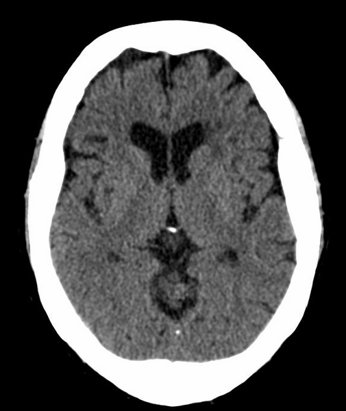 File:Anomalous intracranial venous drainage (Radiopaedia 28161-28418 Axial 23).png