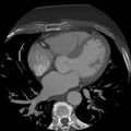 Anomalous origin of left circumflex artery from right coronary sinus (Radiopaedia 72563-83117 A 32).jpg