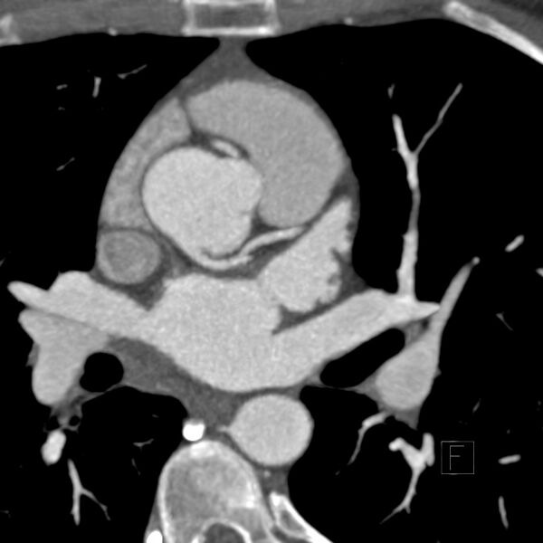 File:Anomalous right coronary artery (ARCA) with interarterial course (Radiopaedia 12423-12677 A 1).jpg