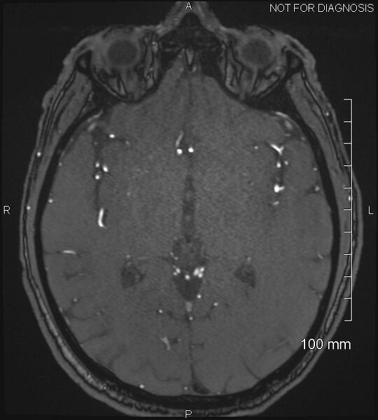 File:Anterior cerebral artery aneurysm (Radiopaedia 80683-94127 Axial MRA 118).jpg