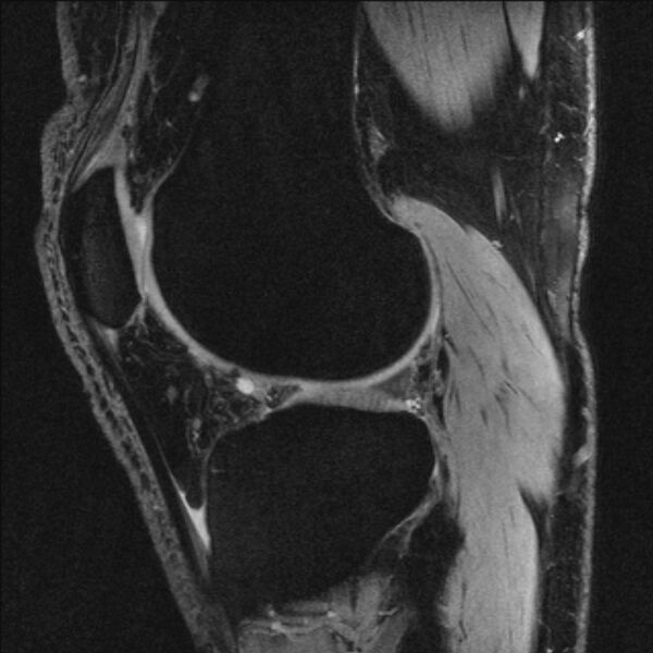 File:Anterior cruciate ligament mucoid degeneration (Radiopaedia 68400-77933 Sagittal 19).jpg