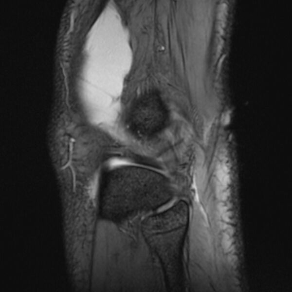 File:Anterior cruciate ligament tear - ramp lesion (Radiopaedia 71883-82322 Sagittal T2 fat sat 4).jpg