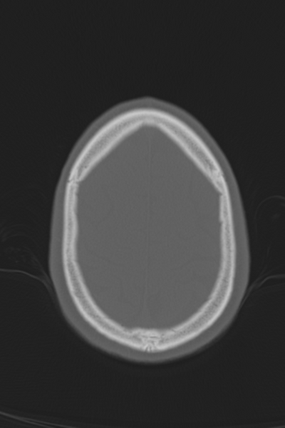 File:Anterior nasal spine fracture (Radiopaedia 46138-50494 Axial bone window 13).png