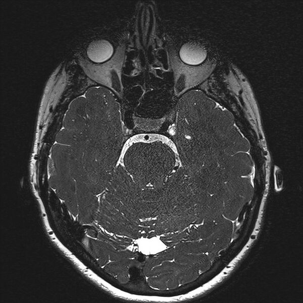 File:Anterior temporal encephalocele (Radiopaedia 82624-96808 Axial T2 high res 59).jpg