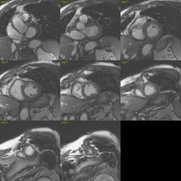 File:Anteroseptal hypokinesia after myocardial infarction (Radiopaedia 15978-15633 E 15).jpg