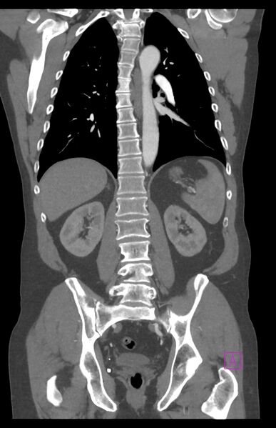 File:Aortectomy and axillary-bifemoral bypass (Radiopaedia 28303-28545 C 61).jpg