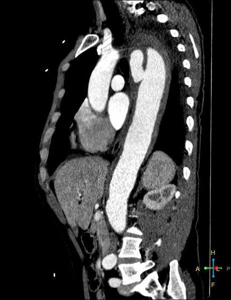 File:Aortic aneurysm and penetrating ulcer (Radiopaedia 23590-23704 C 20).jpg
