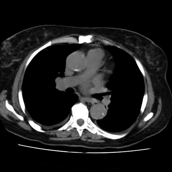 File:Aortic arch pseudoaneurysm (Radiopaedia 8534-9368 Axial non-contrast 37).jpg
