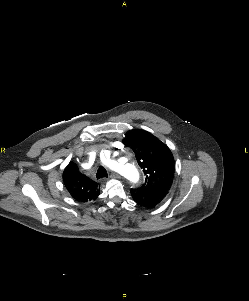 Aortic rupture (Radiopaedia 88822-105594 B 50).jpg