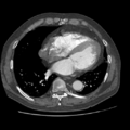 Aorto-coronary bypass graft aneurysms (Radiopaedia 40562-43157 A 83).png