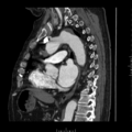 Aorto-coronary bypass graft aneurysms (Radiopaedia 40562-43157 C 21).png