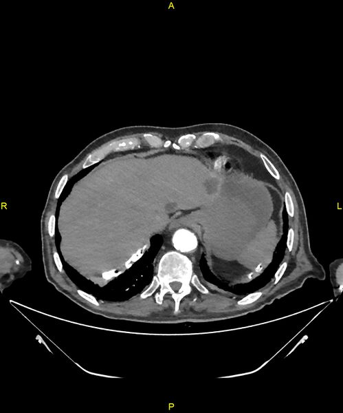 File:Aortoenteric fistula (Radiopaedia 84308-99603 B 31).jpg