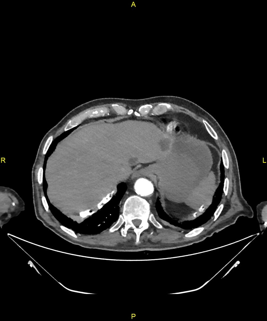 Aortoenteric fistula (Radiopaedia 84308-99603 B 31).jpg