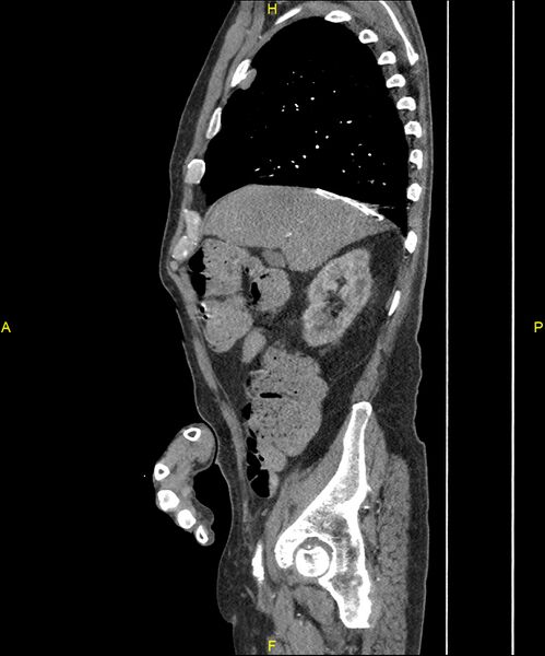 File:Aortoenteric fistula (Radiopaedia 84308-99603 C 94).jpg