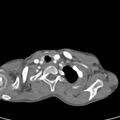 Aortopulmonary window, interrupted aortic arch and large PDA giving the descending aorta (Radiopaedia 35573-37074 B 5).jpg