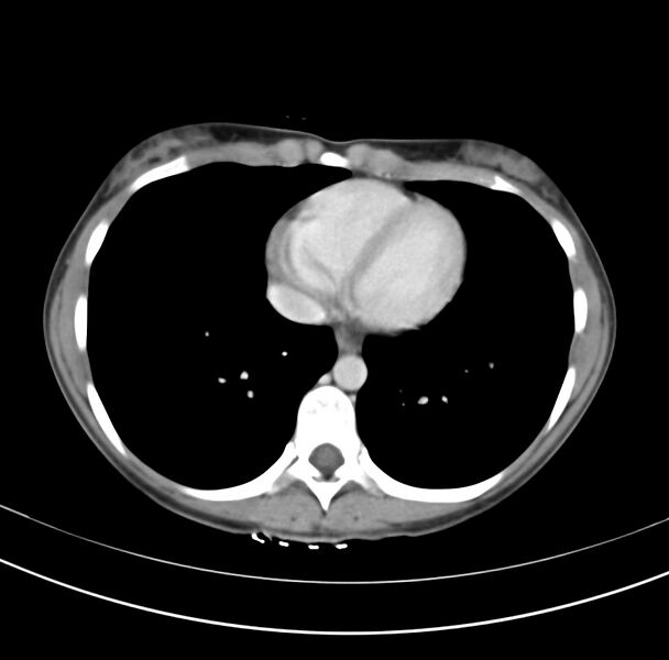 File:Appendicitis and incidental bicornuate uterus (Radiopaedia 22833-22853 B 1).jpg