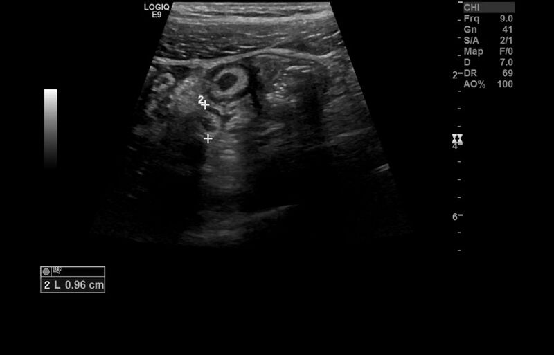 File:Appendicitis and incidental foregut duplication cyst (Radiopaedia 52962-58918 A 7).jpg