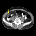 Appendicitis and renal cell carcinoma (Radiopaedia 17063-18402 A 1).png