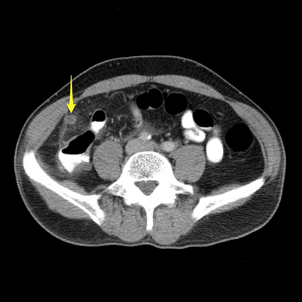 File:Appendicitis and renal cell carcinoma (Radiopaedia 17063-18402 A 1).png