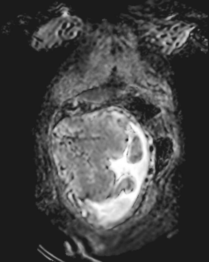 Appendicitis in gravida (MRI) (Radiopaedia 89433-106395 Coronal ADC 13).jpg