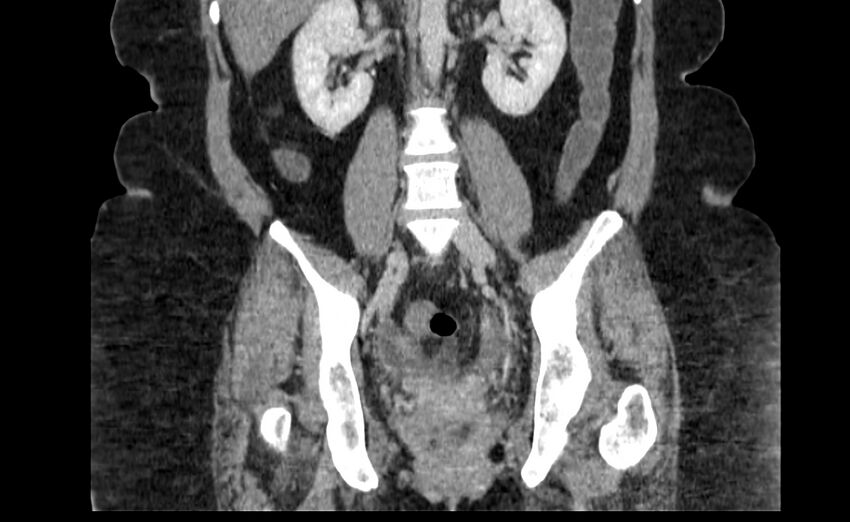 Appendix mucocele (Radiopaedia 41222-44033 B 57).jpg